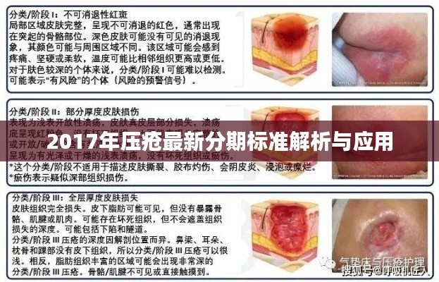 2017年压疮最新分期标准解析与应用