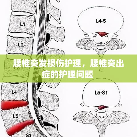 腰椎突发损伤护理，腰椎突出症的护理问题 